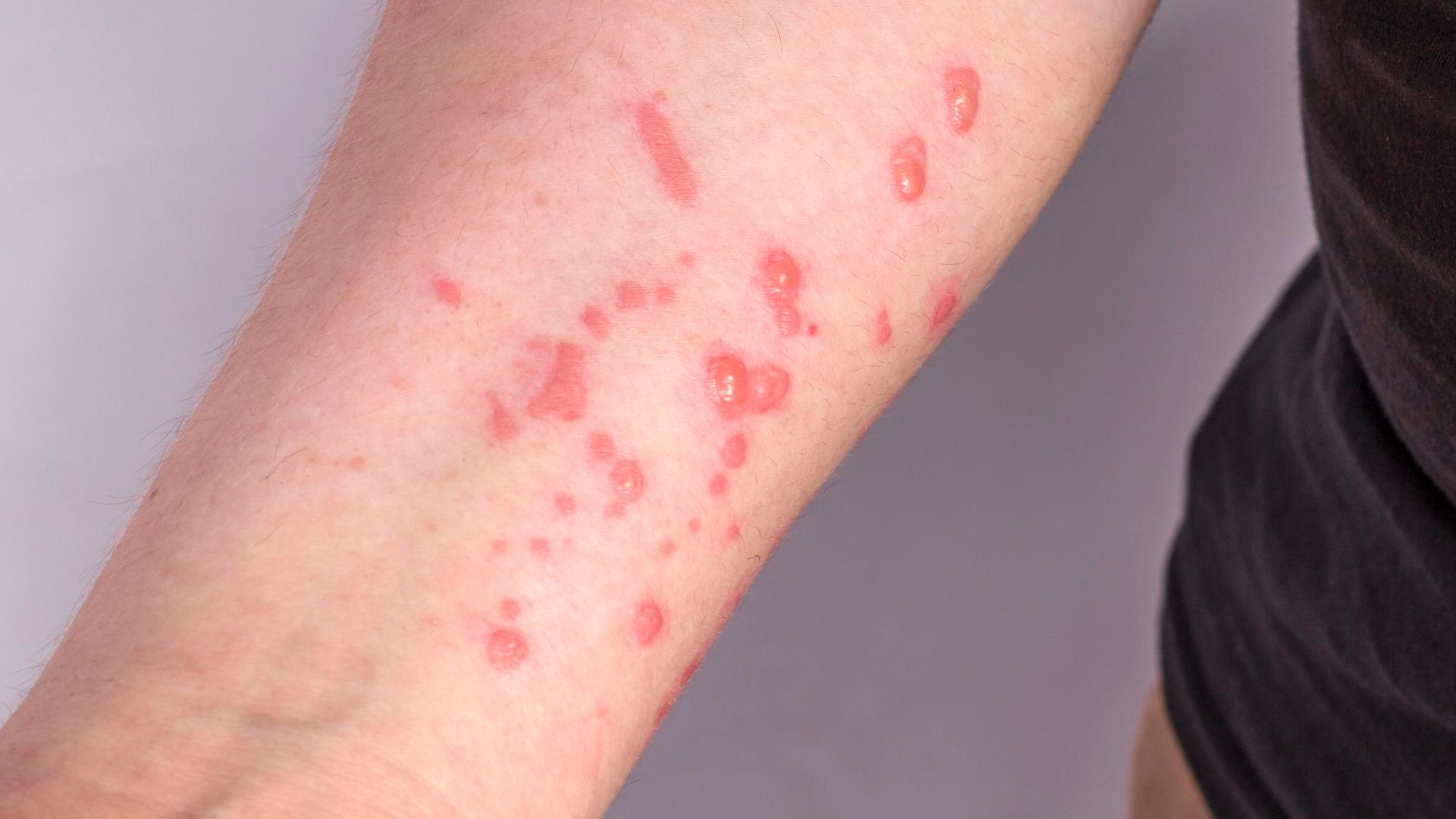 Mato Grosso intensifica vigilância após alerta para nova variante da Mpox