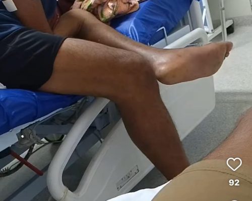 Família denuncia descaso na saúde pública de Cuiabá: paciente com pé necrosado aguarda cirurgia há mais de um mês no HMC