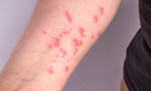 Mato Grosso intensifica vigilância após alerta para nova variante da Mpox