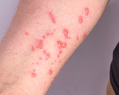 Mato Grosso intensifica vigilância após alerta para nova variante da Mpox