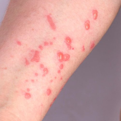 Mato Grosso intensifica vigilância após alerta para nova variante da Mpox